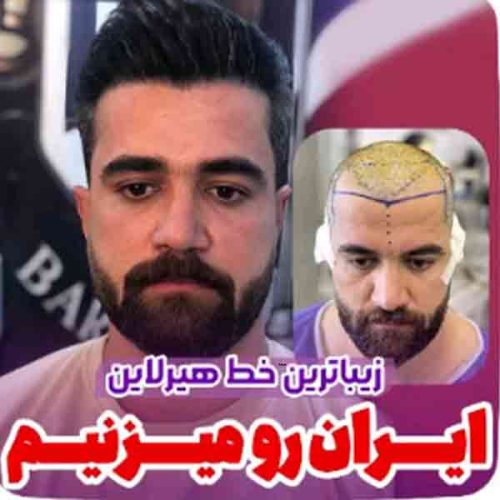 hair-transplant26