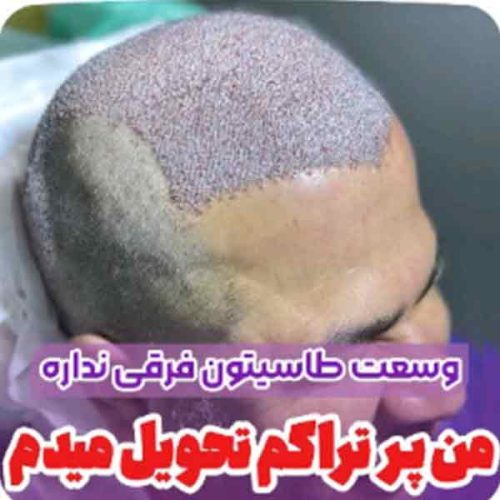 hair-transplant3