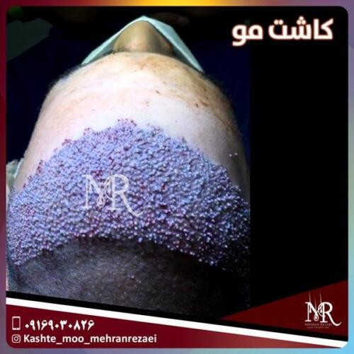 کاشت-مو-1