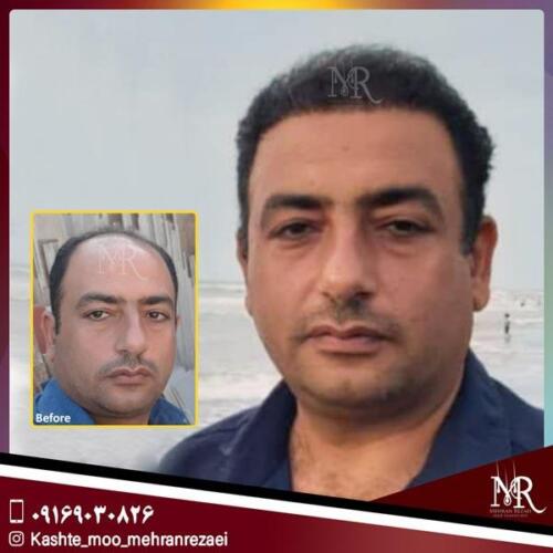 کاشت-مو-4