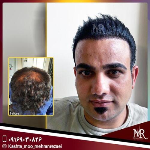 کاشت-مو-5